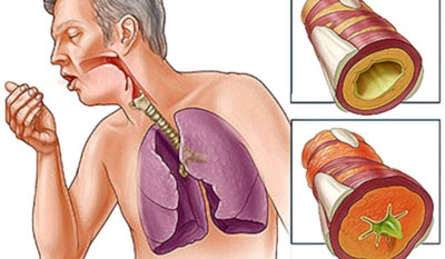 Применение Флуимуцила при заболеваниях дыхательной системы
