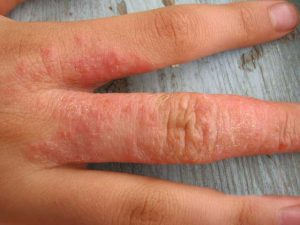 Признаки и лечение аллергического артрита у взрослых и детей