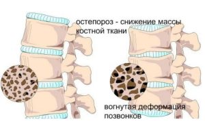 Виды и лечение переломов поясничного отдела позвоночника