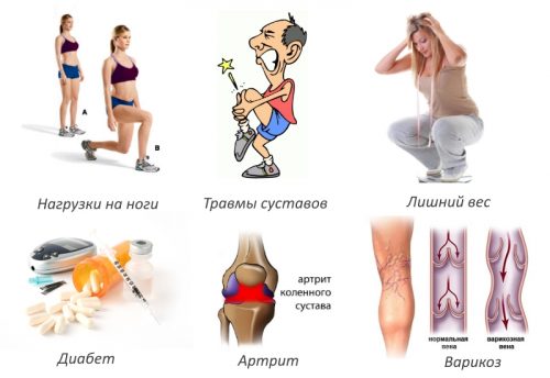 Характерные симптомы и способы лечения артроза нижних конечностей