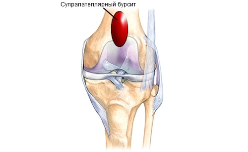 Симптомы и лечение супрапателлярного бурсита коленного сустава