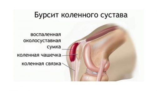 Симптомы и лечение бурсита коленного сустава