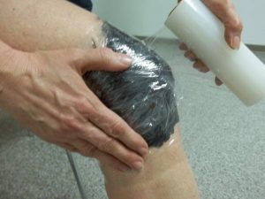 Стадии и лечение остеоартроза коленного сустава