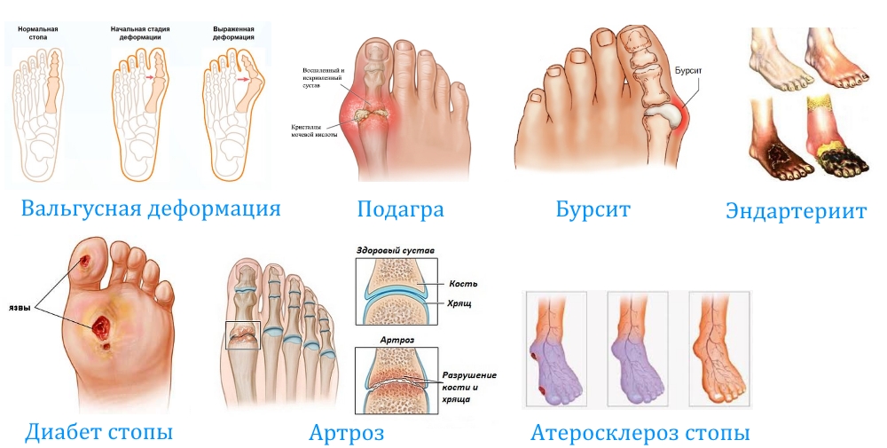 Причины боли в большом пальце ноги и способы ее устранения