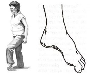 Проявление и методы лечения конской стопы у человека