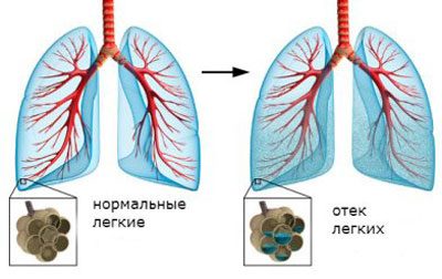 Симптомы, причины и эффективные методы устранения альвеолита лёгких