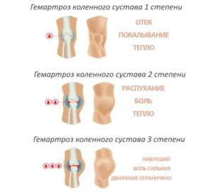 Скопление жидкости в коленном суставе: симптомы, причины и лечение