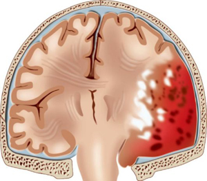 Виды, лечение и последствия перелома основания черепа