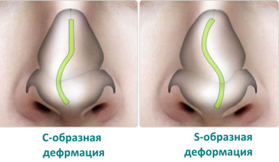 Показания для промывания носа Хлоргексидином при насморке и гайморите