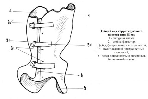Использование ортопедического корсета Шено при сколиозе
