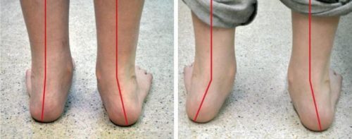 Лечение вальгусного искривления ног у ребенка