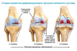 Что делать и как лечить внезапную острую боль в колене: первая помощь при травмах