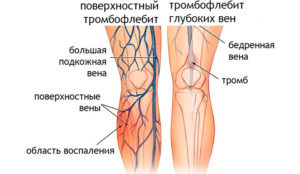 Почему горят мышцы ноги в передней части бедра выше колена
