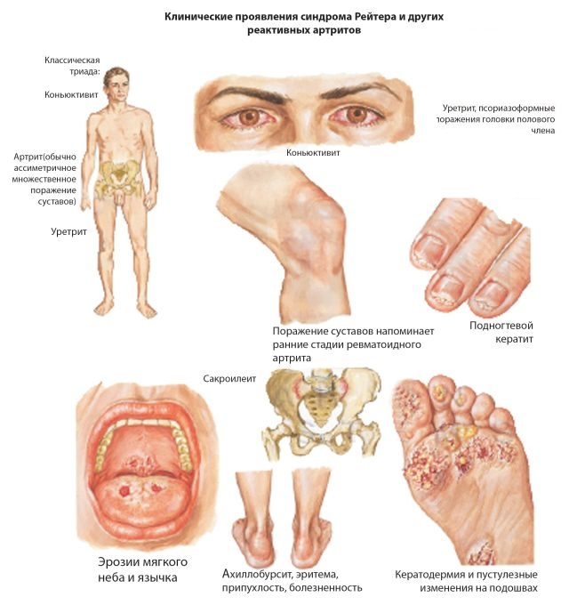 Реактивный артрит: симптомы, лечение, диагностика