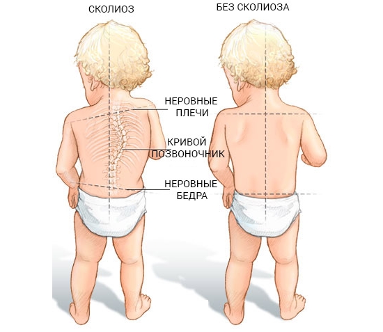 Причины боли в спине у ребенка и способы ее устранения