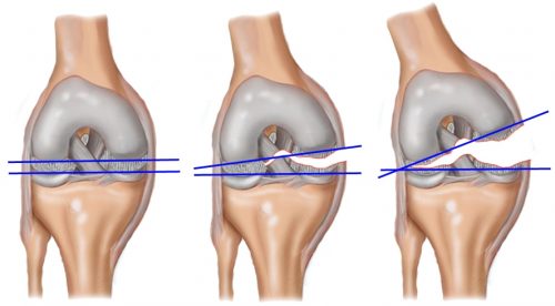 Особенности лечения гемартроза коленного сустава