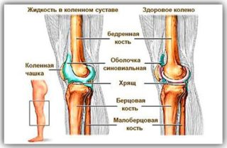 Скопление жидкости в коленном суставе: симптомы, причины и лечение