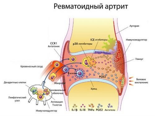 Особенности питания при ревматоидном артрите суставов