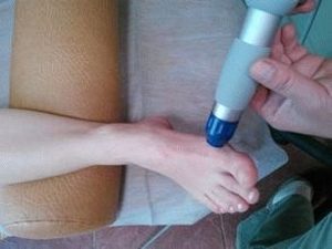 Как остановить рост косточки на ноге возле большого пальца?