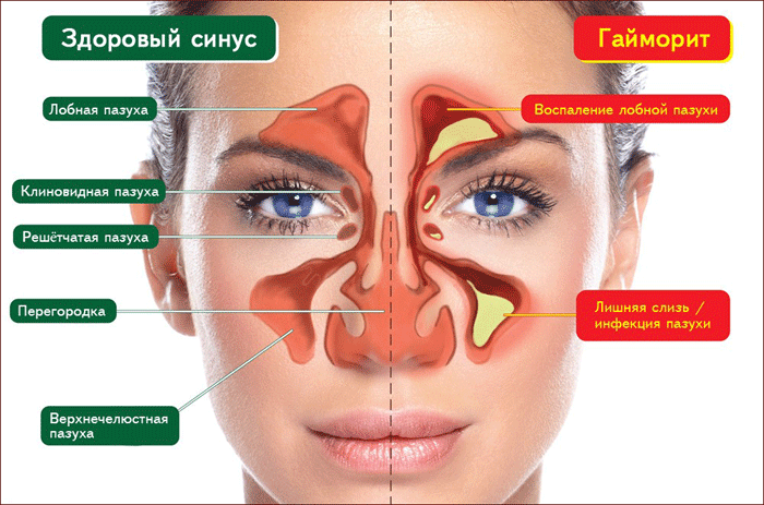 Особенности строения и функции верхнечелюстной пазухи, заболевания синусов носа