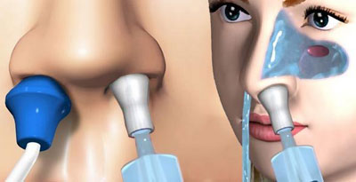 Промывания носа «кукушка»: все самое важное о процедуре
