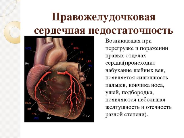 Симптомы при правожелудочковой сердечной недостаточности
