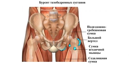 Симптомы и лечение бурсита тазобедренного сустава