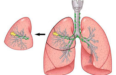 Особенности течения мелкоклеточного рака лёгкого: методы диагностики и лечения