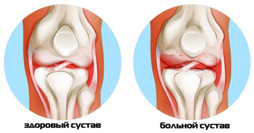 Особенности лечения артрита коленного сустава различных форм