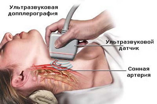 Лечение синдрома позвоночной артерии при шейном остеохондрозе