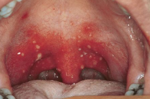 Боль в горле без кашля и температуры: причины и особенности лечения