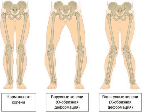 Особенности проявления варусной деформации коленных суставов