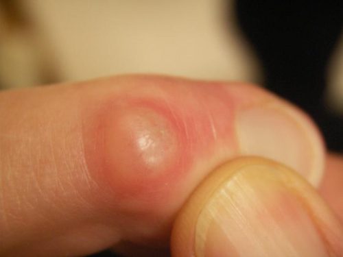 Особенности лечения шишки на суставах пальцев руки