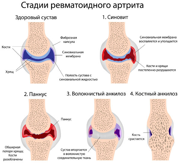 Серонегативный и серопозитивный ревматоидный артрит: отличия, стадии, лечение
