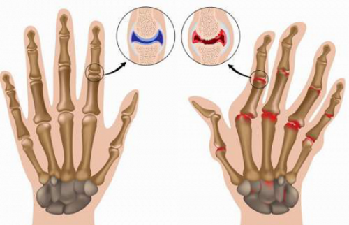 Почему хрустят суставы на пальцах рук: вредно или нет для здоровья?