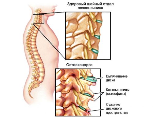 Причины и лечение обострения шейного остеохондроза