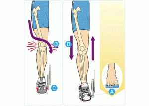 Особенности проявления варусной деформации коленных суставов