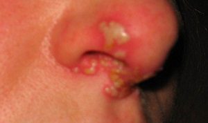 Герпес на носу: фото, симптомы, лечение, меры профилактики у взрослых и детей