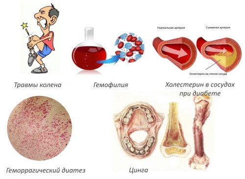 Особенности лечения гемартроза коленного сустава