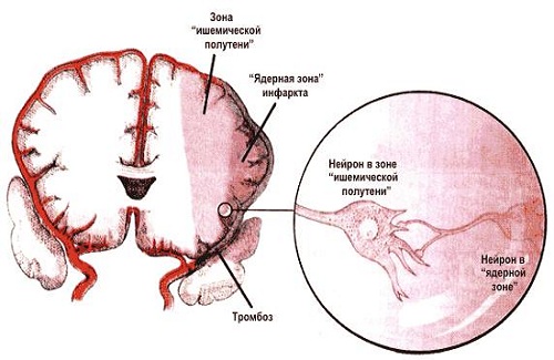 Как провести эффективное лечение ишемии головного мозга в соответствии с её проявлениями?