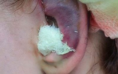 Особенности лечения ушиба уха