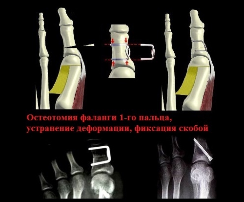 Как остановить рост косточки на ноге возле большого пальца?