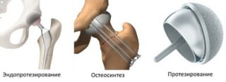 Замена сустава при переломе шейки бедра: противопоказания, подготовка, отзывы и можно ли обойтись без операции
