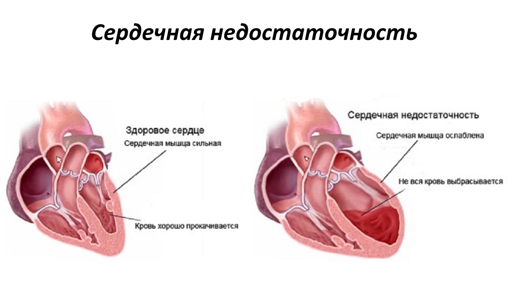 Лечение сердечной недостаточности средствами народной медицины