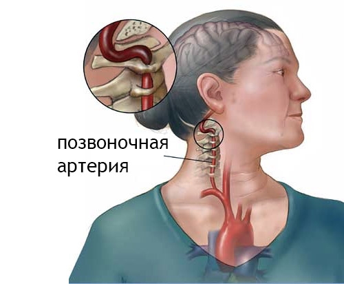 Улучшаем мозговое кровообращение при остеохондрозе шеи
