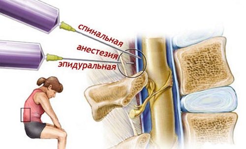 Симптомы и лечение грыжи Шморля грудного отдела позвоночника