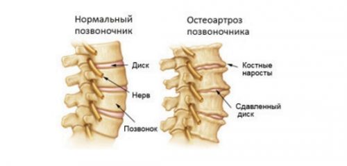 Почему возникает боль в области шеи с левой стороны?