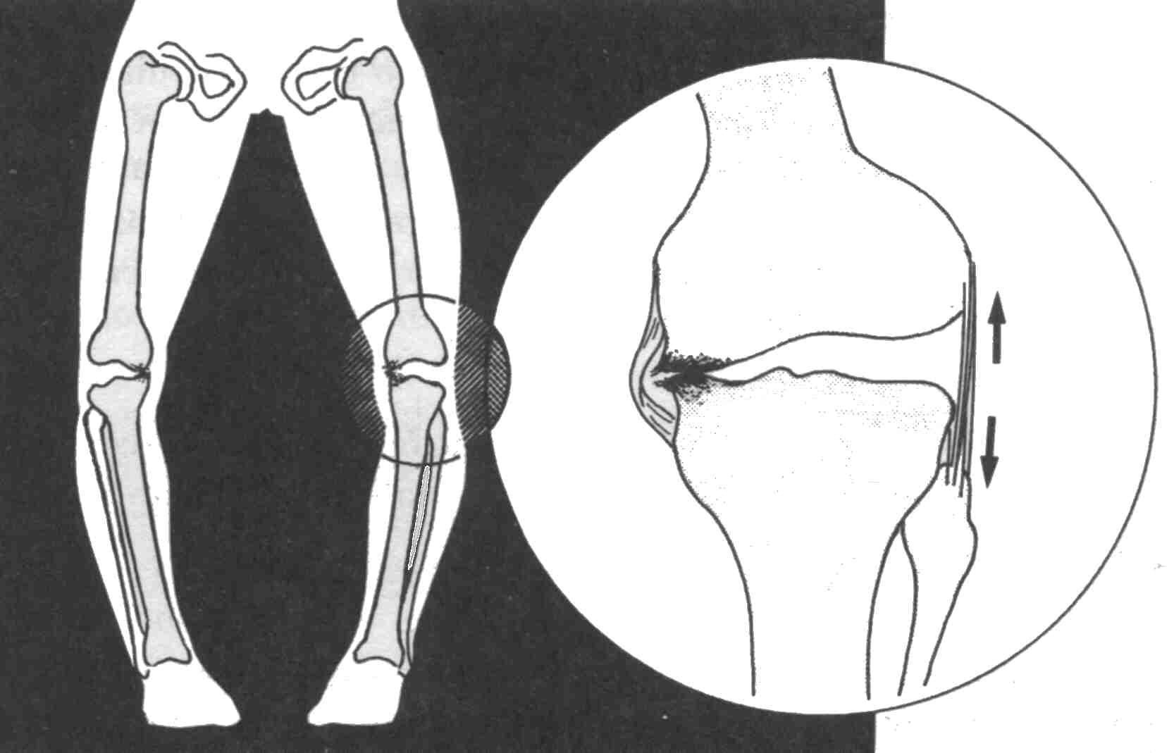 Признаки и лечение дисплазии коленного сустава