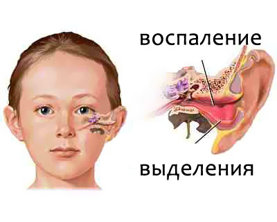 Болит ухо при насморке у ребёнка