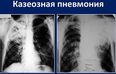 Отличие пневмонии от туберкулёза